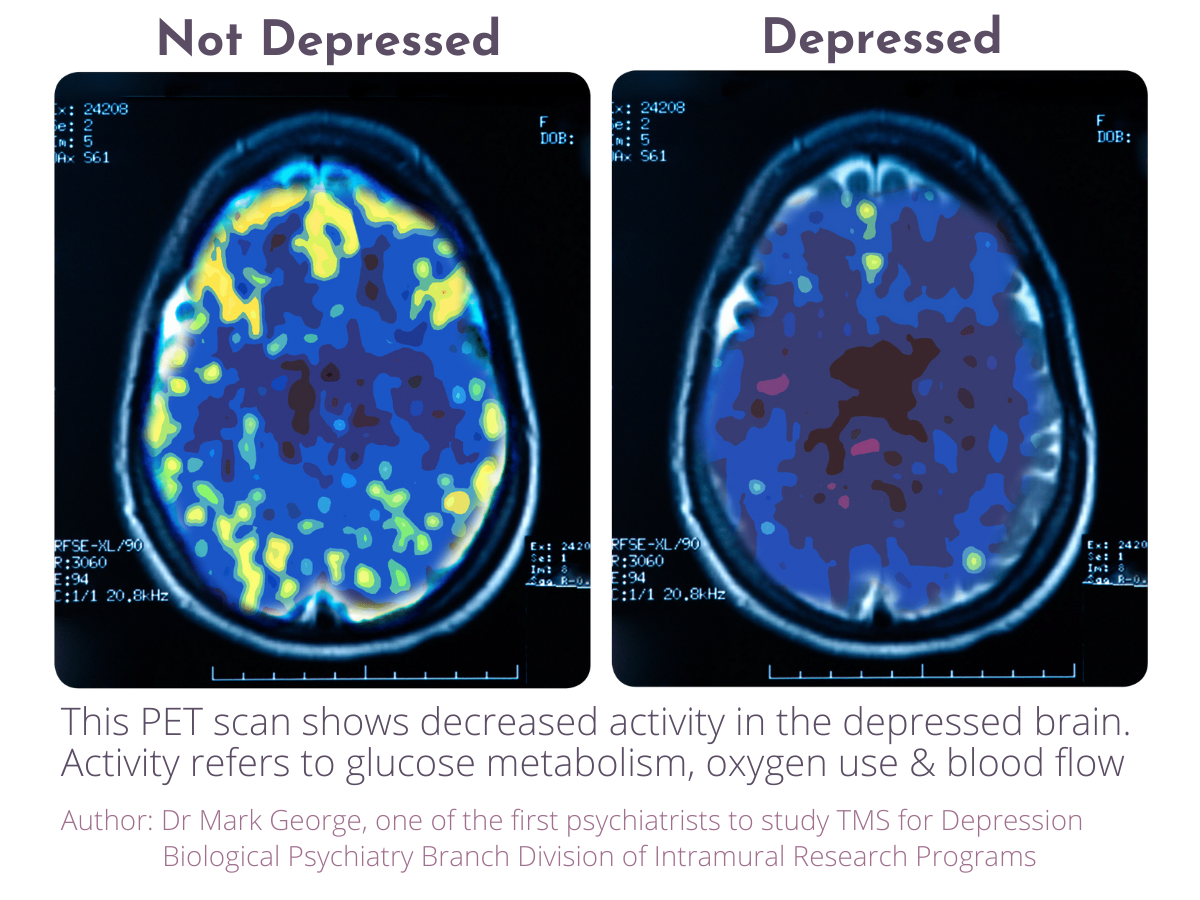 Comparison of PET Scan of patients with depression and without depression