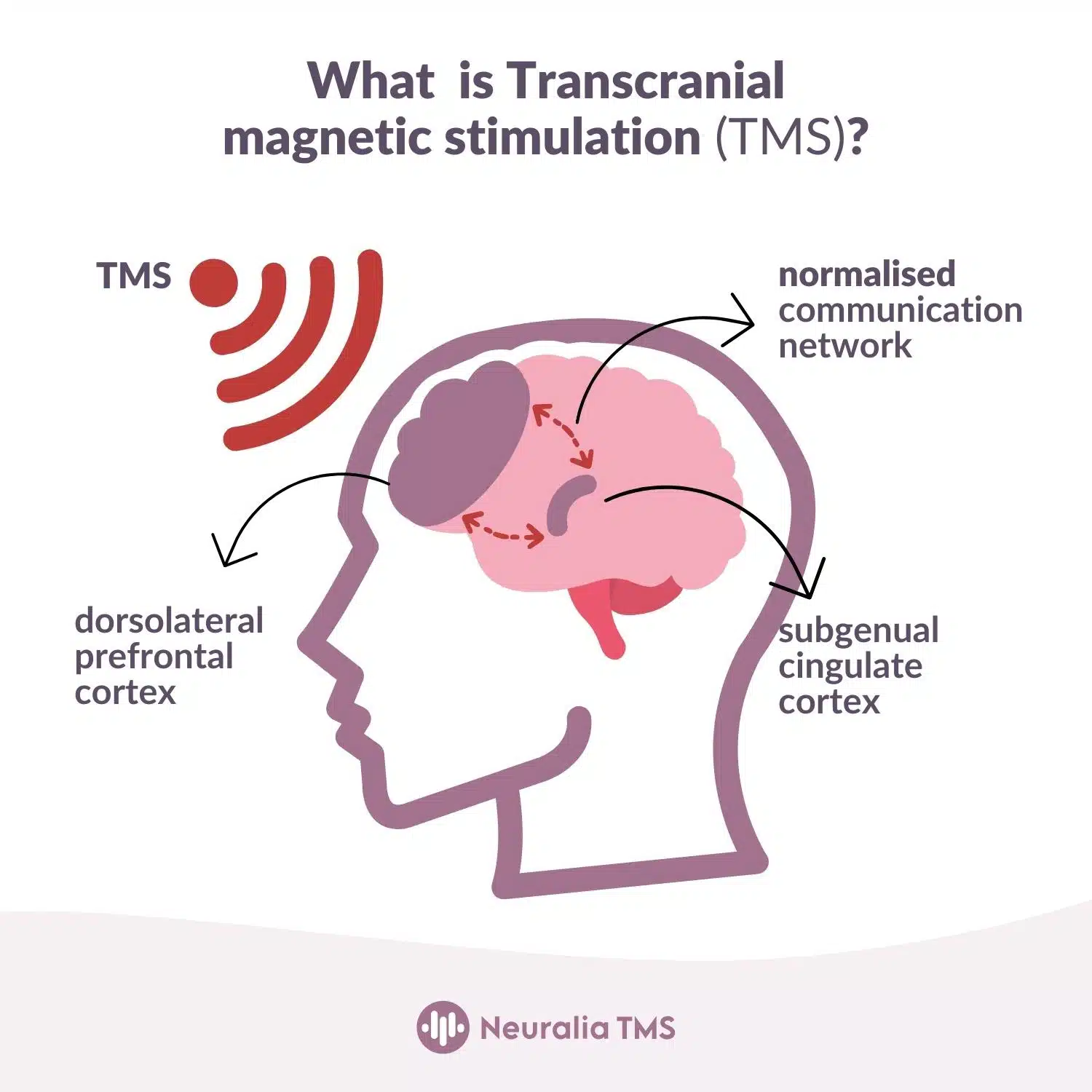 TMS What is Transcranial Stimulation Therapy?